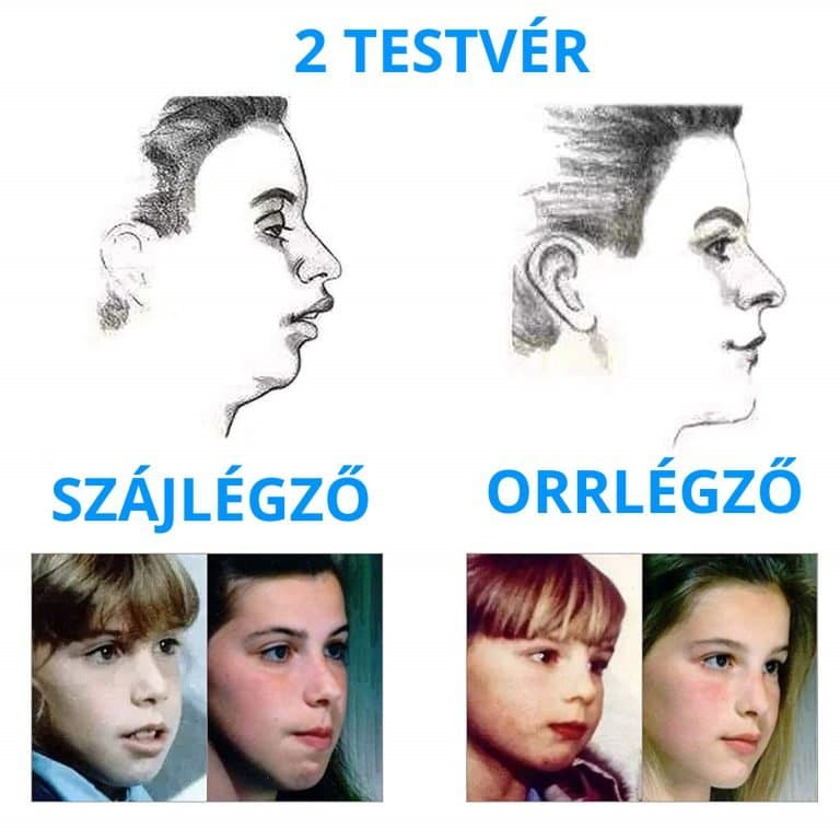 Állkapocs erősítés - A szép arc és fogak titka